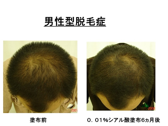 円形脱毛症　病院